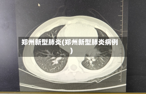 郑州新型肺炎(郑州新型肺炎病例)-第3张图片
